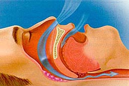 Tratamento do Ronco e Apnéia